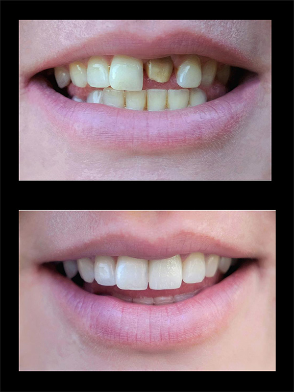 Dental Crowns Before & After Image