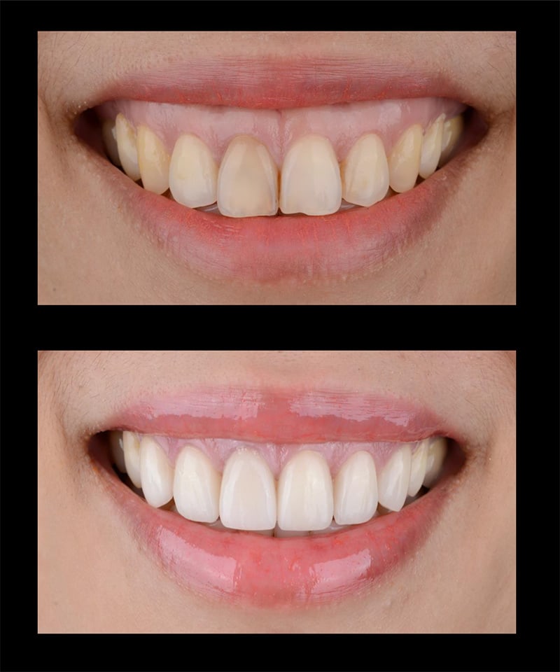 Dental Veneers Before & After Image