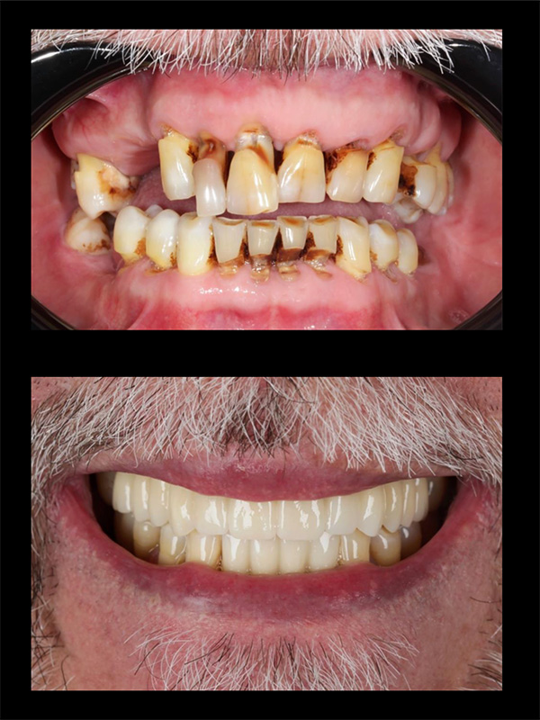 Dental Veneers Before & After Image