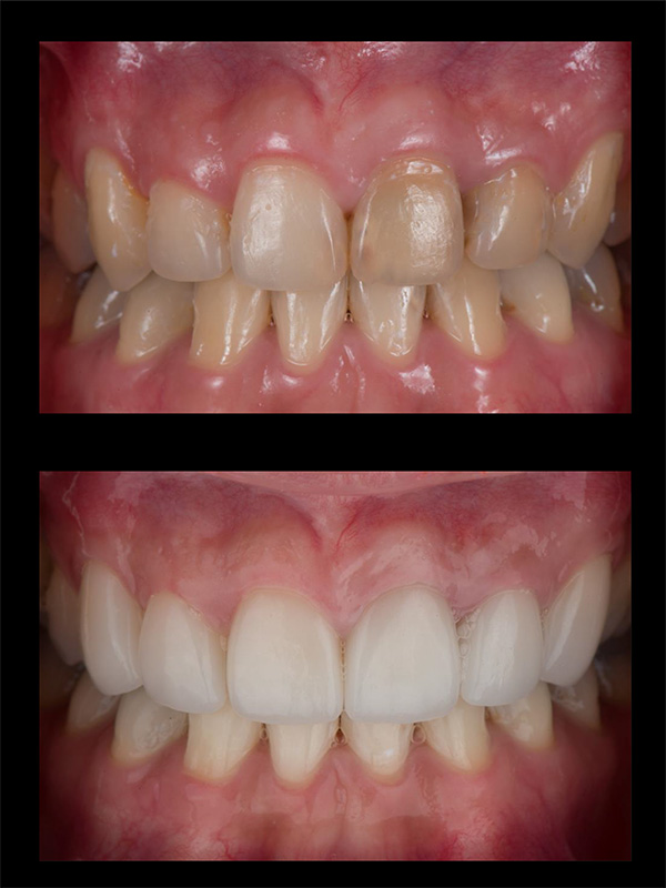 Dental Veneers Before & After Image