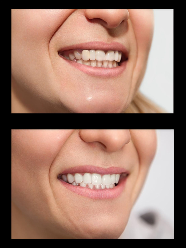 Dental Veneers Before & After Image