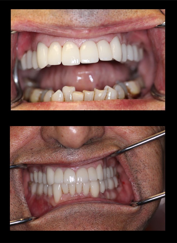 Full Mouth Reconstruction Before & After Image