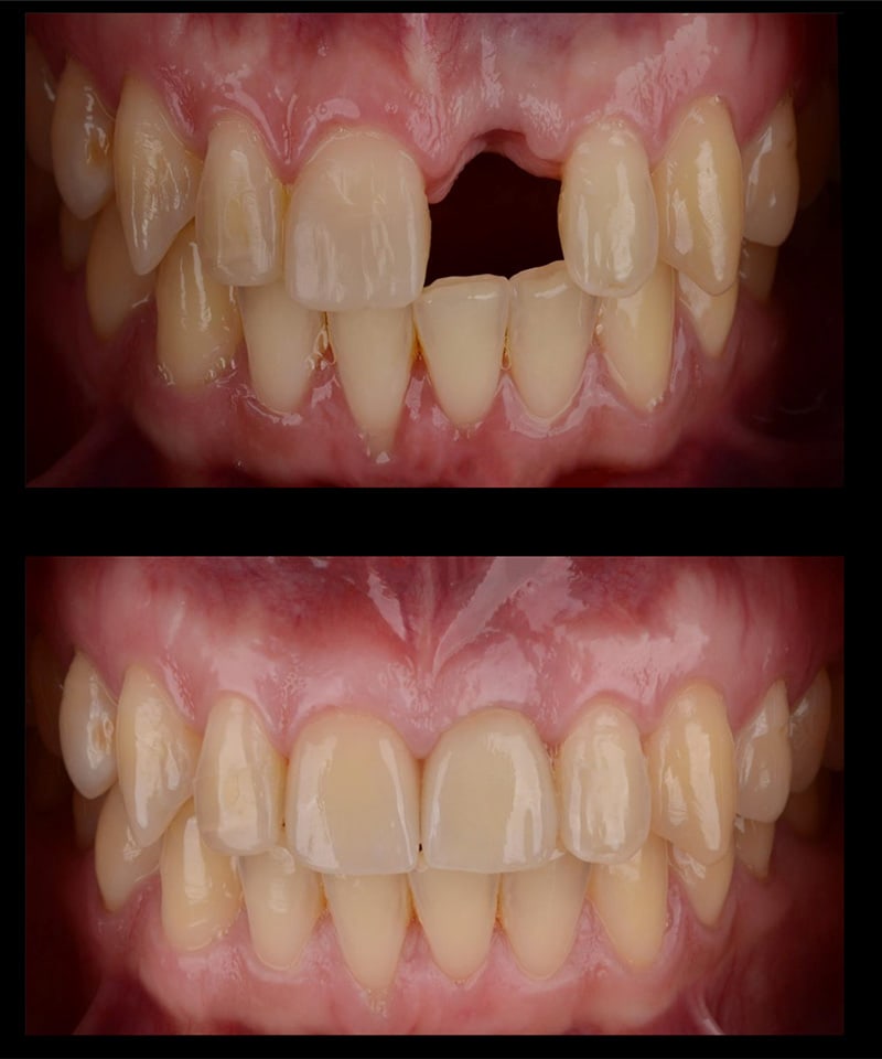 Dental Implants Before & After Image