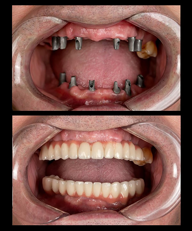 Dental Implants Before & After Image