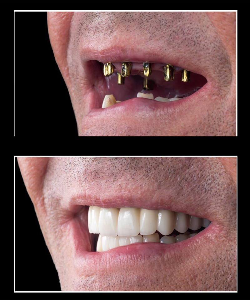 Dental Implants Before & After Image