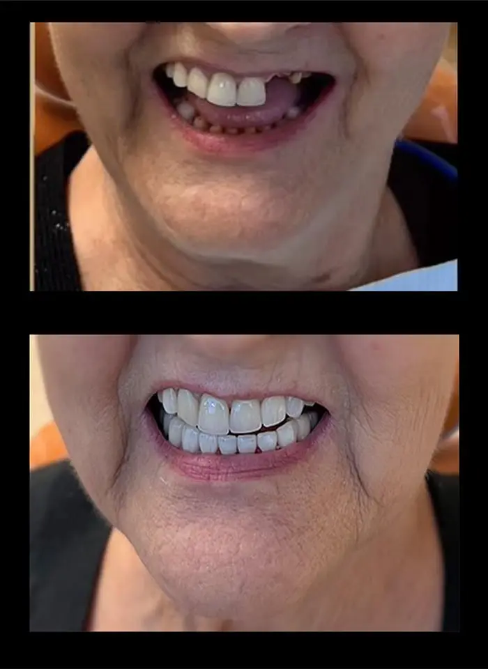 "Full mouth reconstruction before and after completed by Dr. Reza Tafreshi"