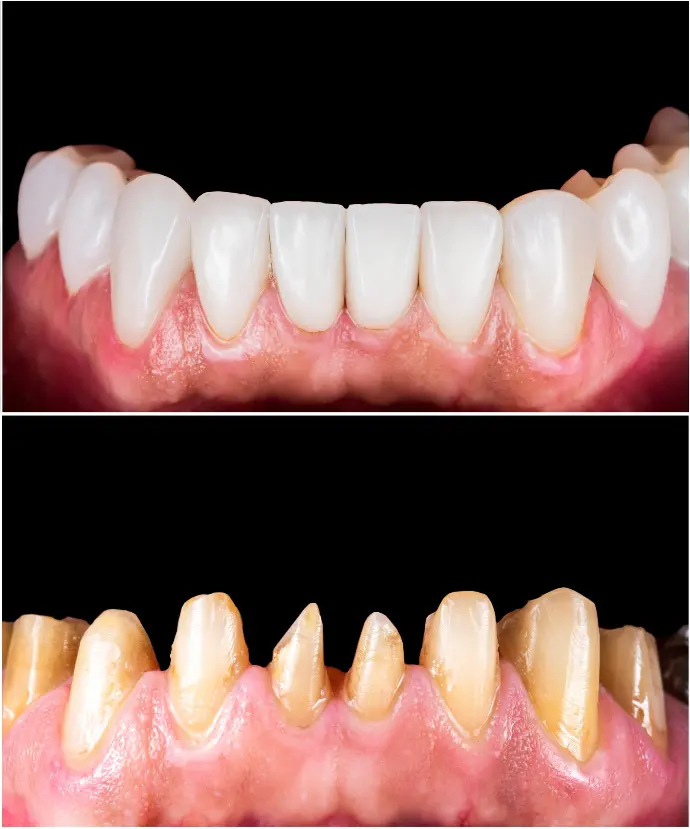 Dental Crown before and after in Aliso Vijeo Orange County