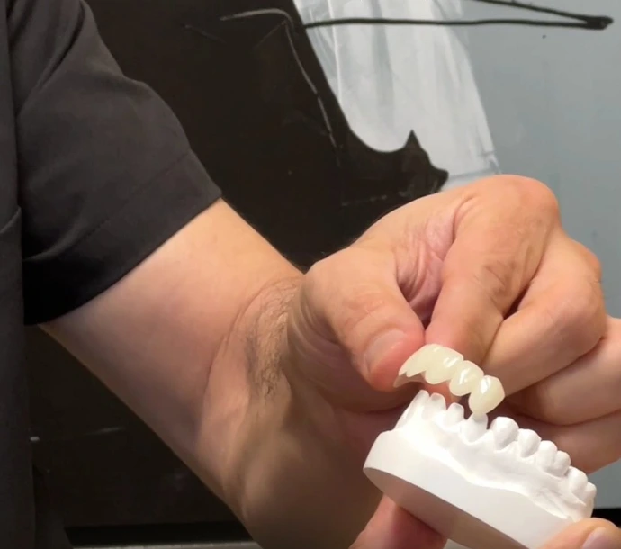Natural Dental Bridges At AVF Aliso Vijeo